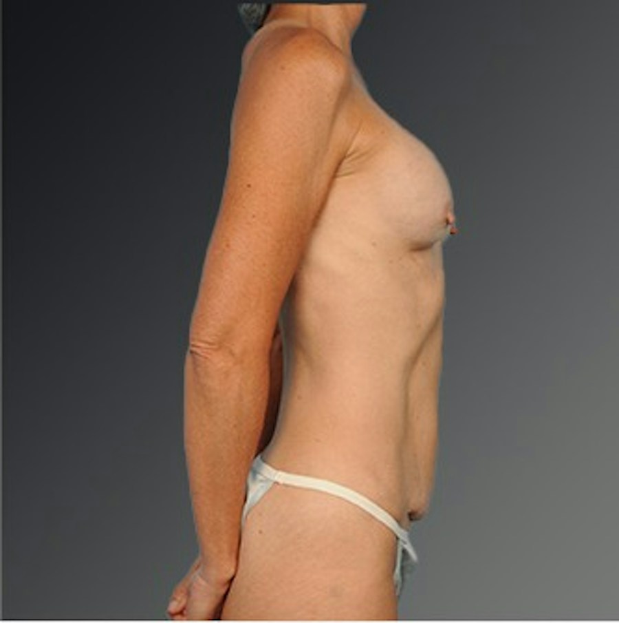 Patient 105714130 | Profile View | Before | Mommy Makeover — Steven Teitelbaum MD -