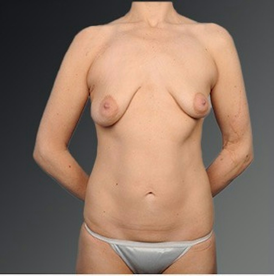 Patient 105714131 | Front View | Before | Mommy Makeover — Steven Teitelbaum MD -