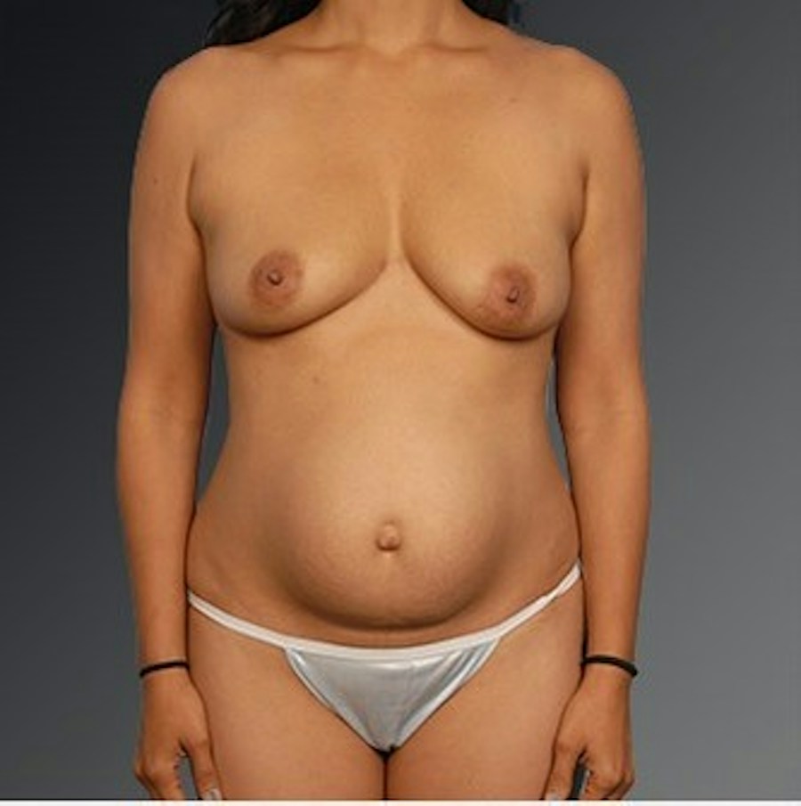 Patient 105714133 | Front View | Before | Mommy Makeover — Steven Teitelbaum MD -