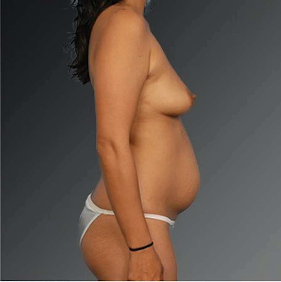 Patient 105714133 | Profile View | Before | Mommy Makeover — Steven Teitelbaum MD -