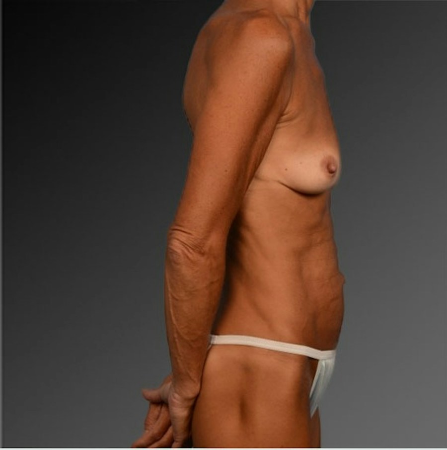 Patient 105714134 | Profile View | Before | Mommy Makeover — Steven Teitelbaum MD -