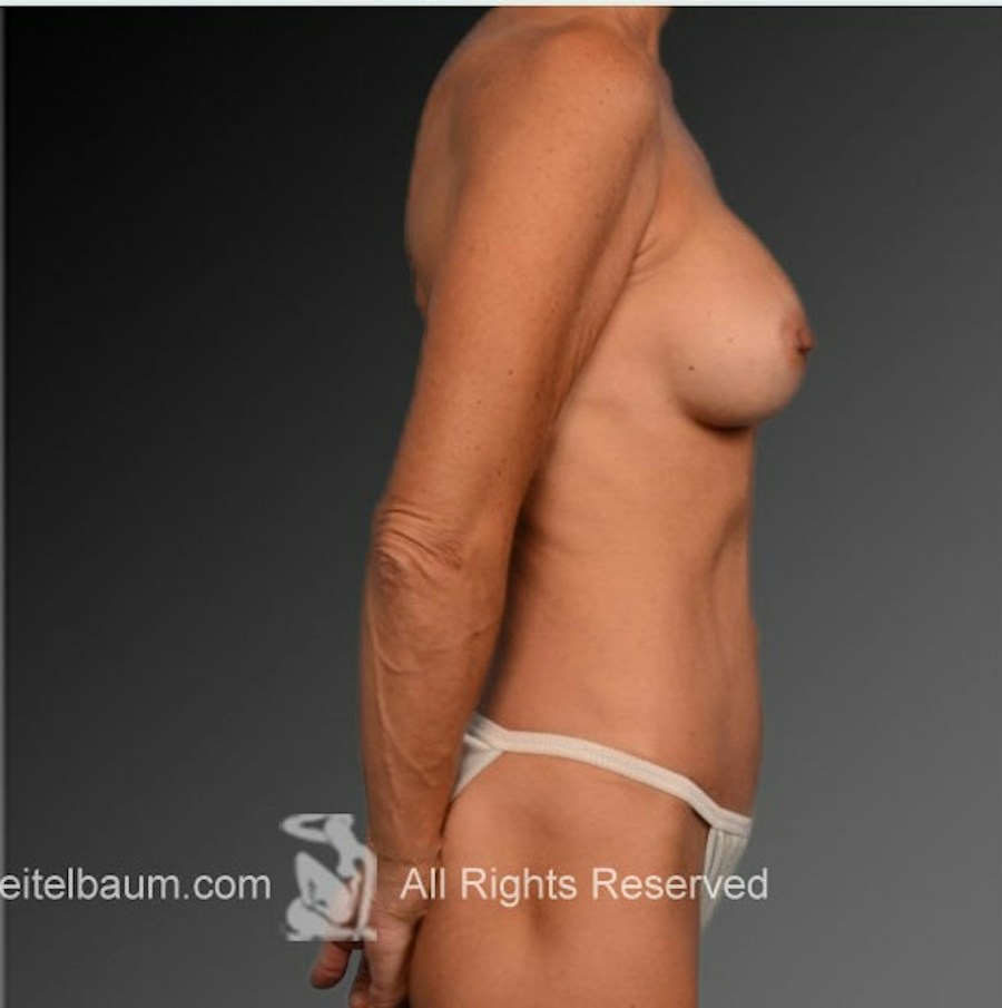 Patient 105714134 | Profile View | After | Mommy Makeover — Steven Teitelbaum MD -