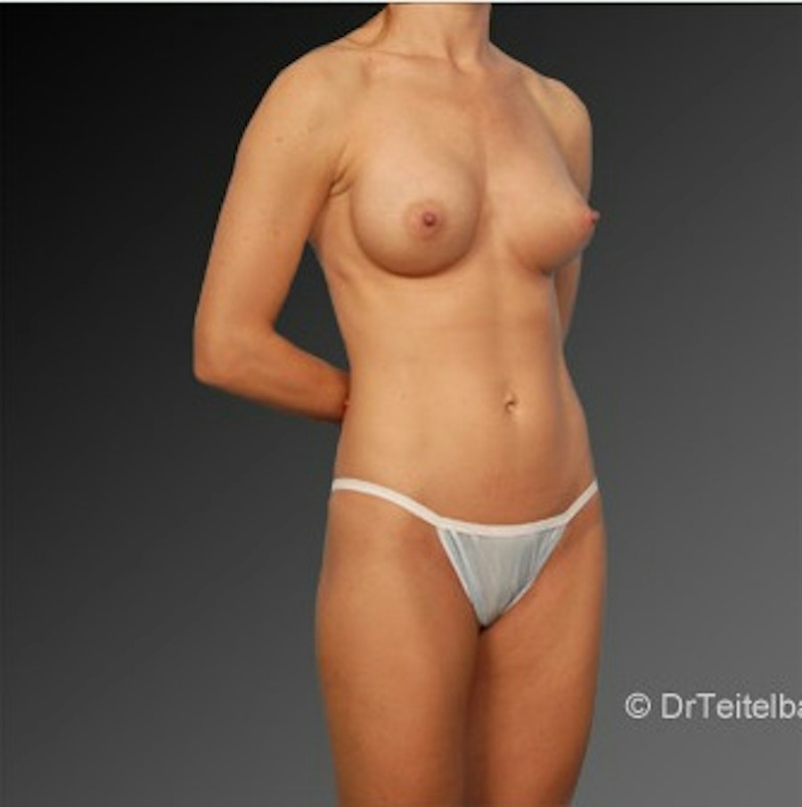 Patient 105714139 | Angle View | After | Mommy Makeover — Steven Teitelbaum MD -