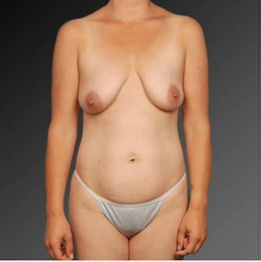 Patient 105714141 | Front View | Before | Mommy Makeover — Steven Teitelbaum MD -