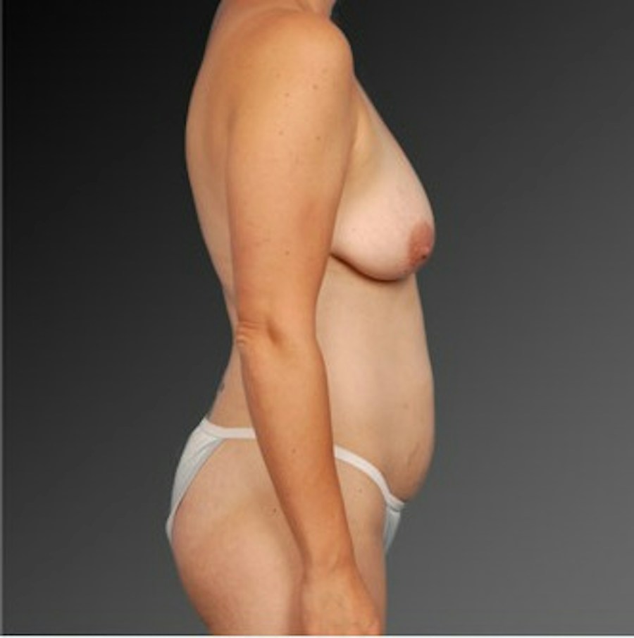 Patient 105714141 | Profile View | Before | Mommy Makeover — Steven Teitelbaum MD -