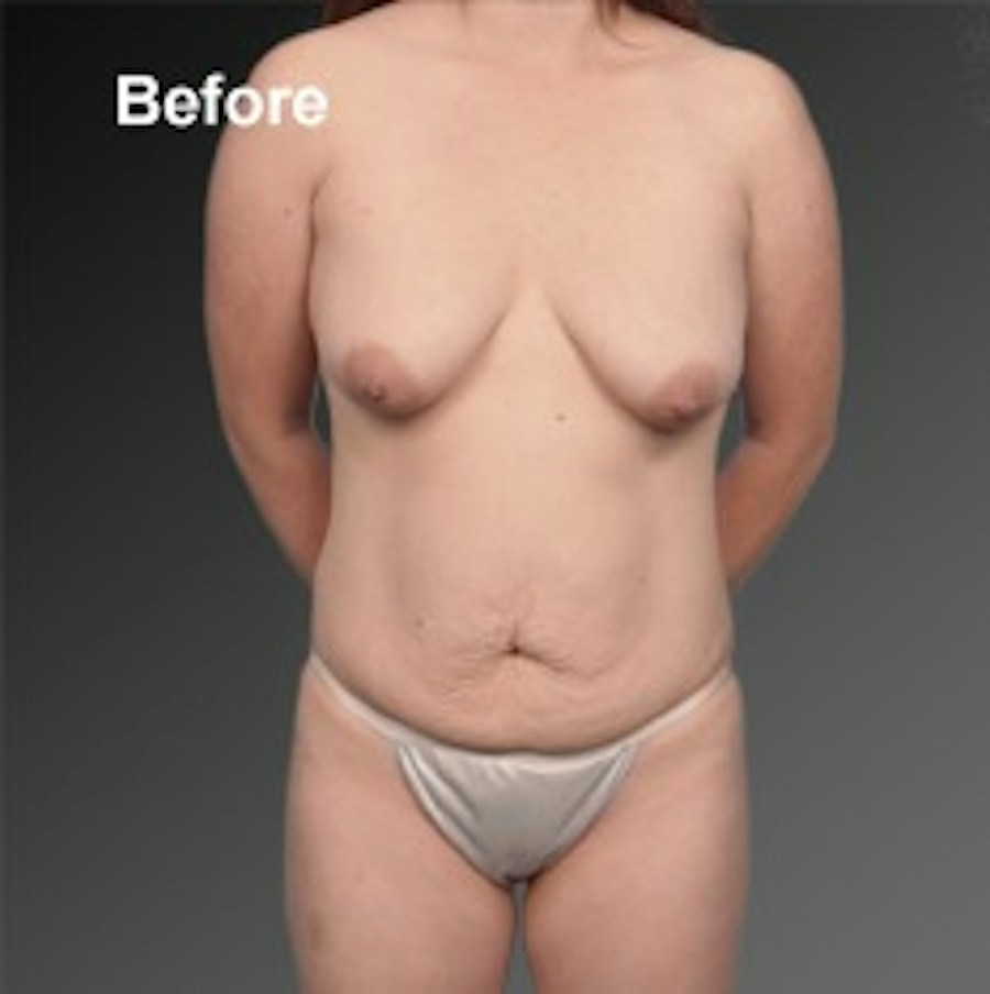 Patient 105714143 | Front View | Before — Steven Teitelbaum MD -
