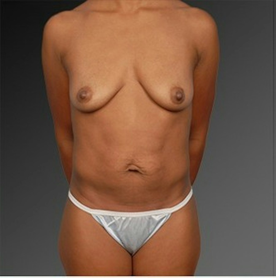Patient 105714146 | Front View | Before | Mommy Makeover — Steven Teitelbaum MD -