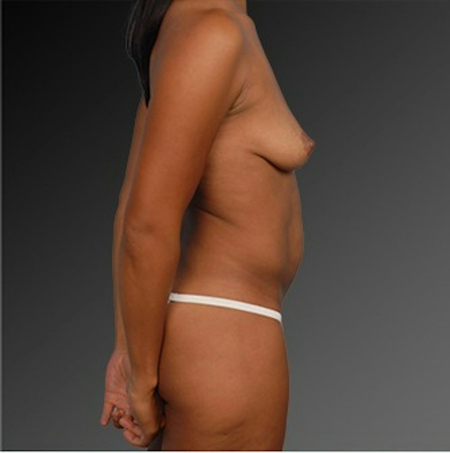 Patient 105714146 | Profile View | Before | Mommy Makeover — Steven Teitelbaum MD -