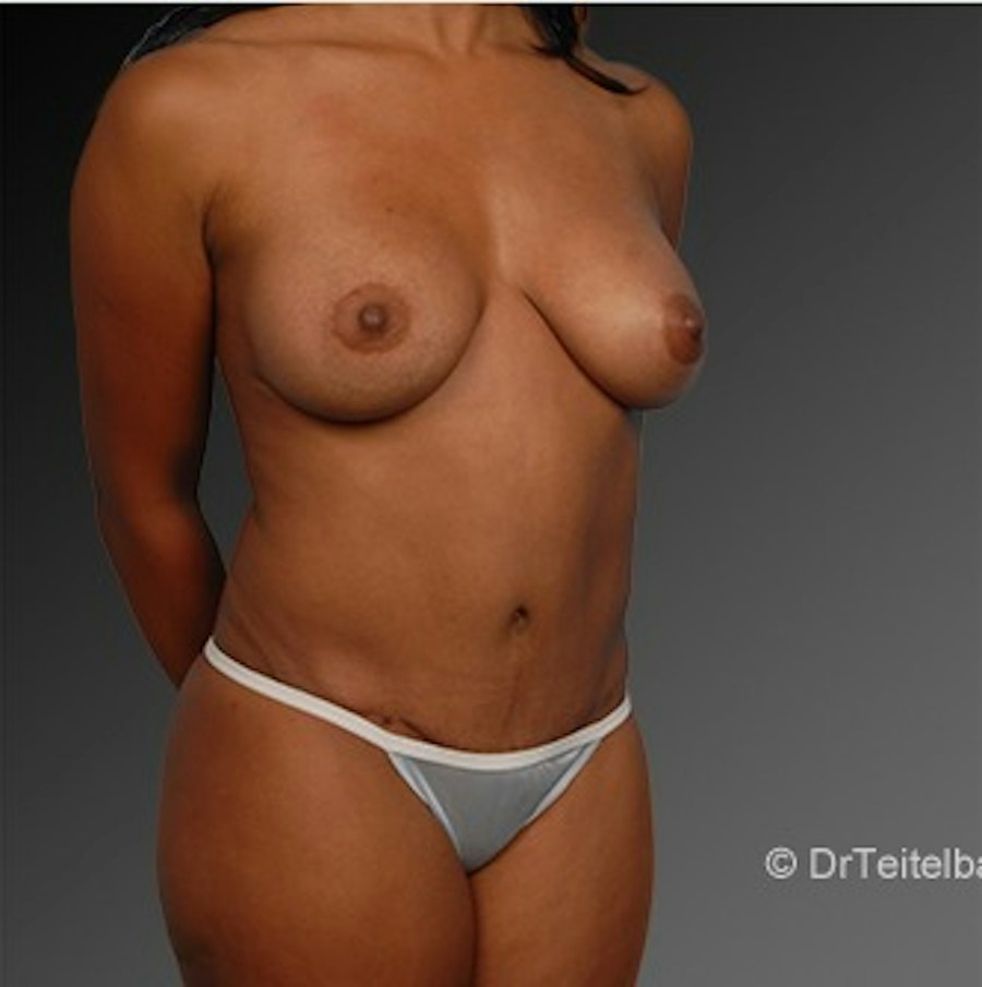 Patient 105714146 | Angle View | After | Mommy Makeover — Steven Teitelbaum MD -