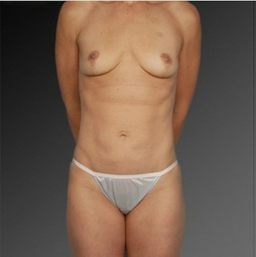 Patient 105714148 | Front View | After — Steven Teitelbaum MD -