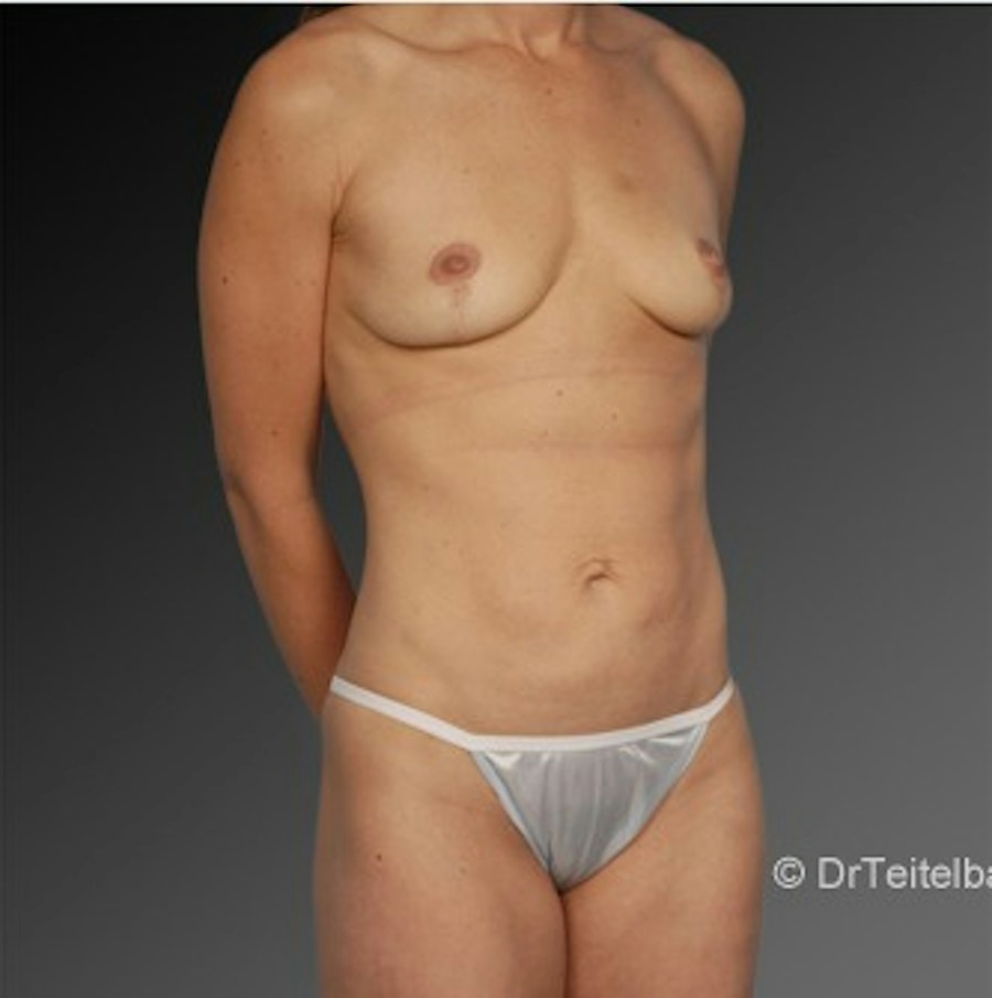 Patient 105714148 | Angle View | After — Steven Teitelbaum MD -