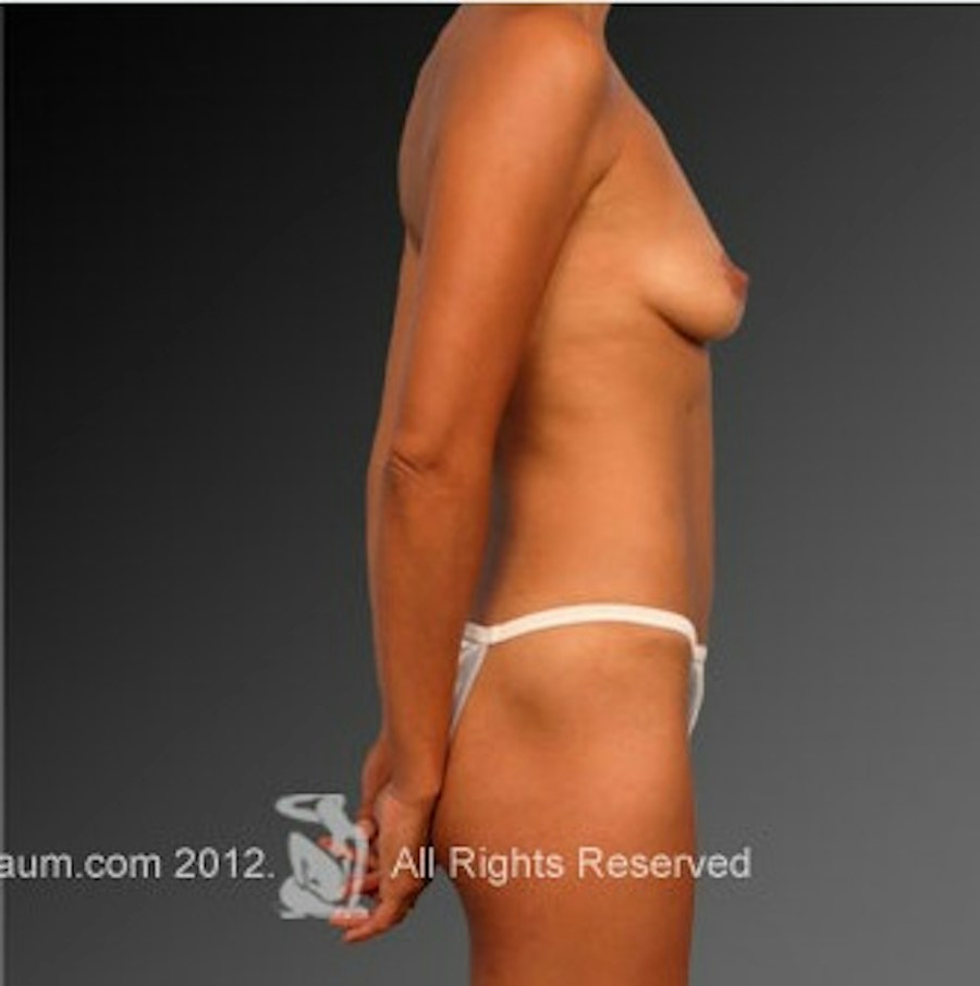 Patient 105714846 | Profile View | After | Mommy Makeover — Steven Teitelbaum MD -