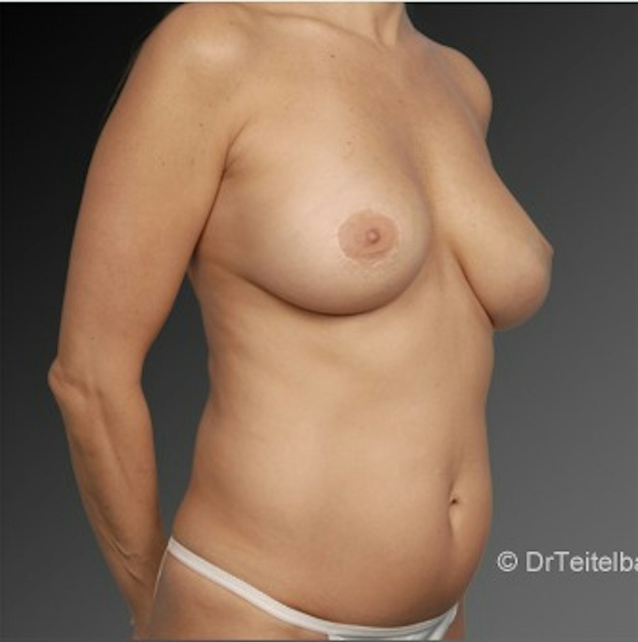 Patient 105736471 | Angle View | After — Steven Teitelbaum MD -