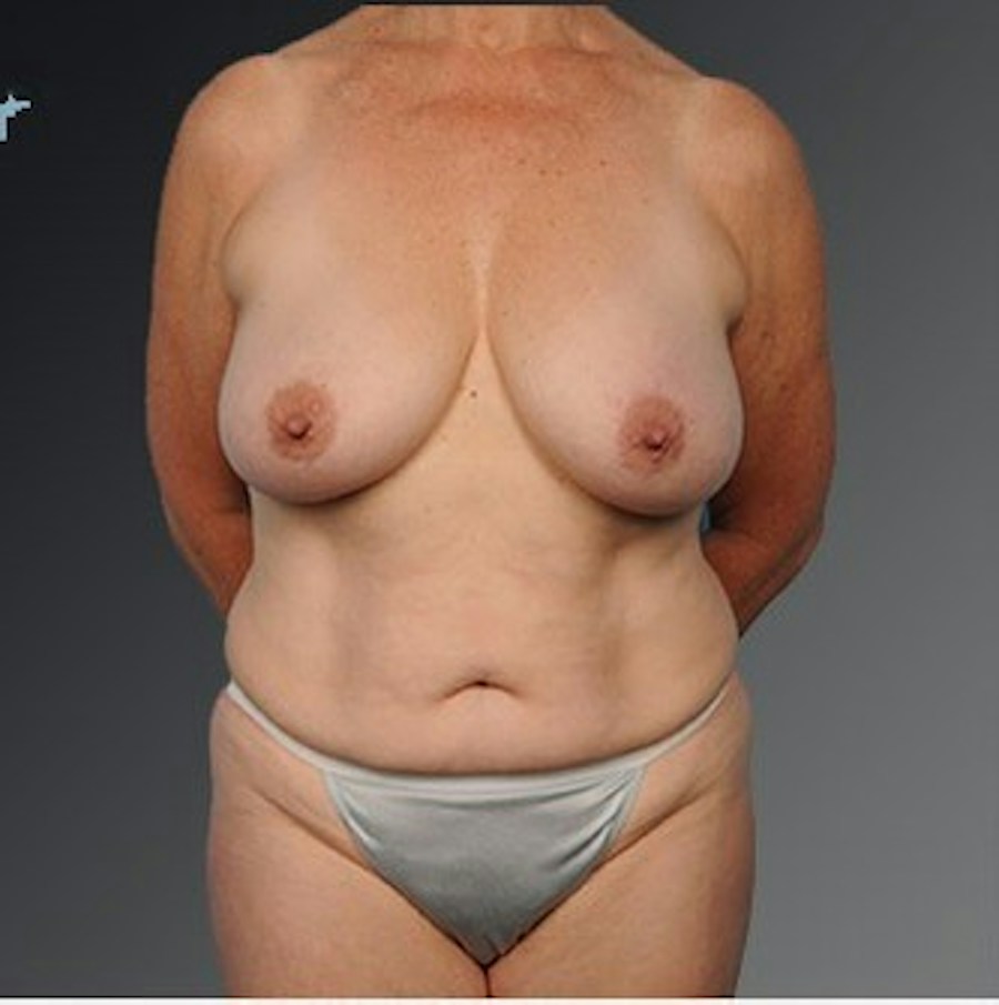 Patient 105741254 | Front View | Before | Mommy Makeover — Steven Teitelbaum MD -