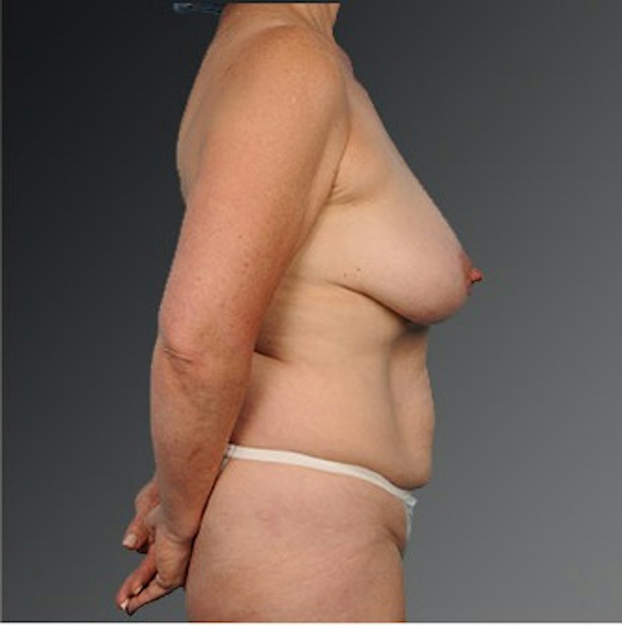 Patient 105741254 | Profile View | Before | Mommy Makeover — Steven Teitelbaum MD -