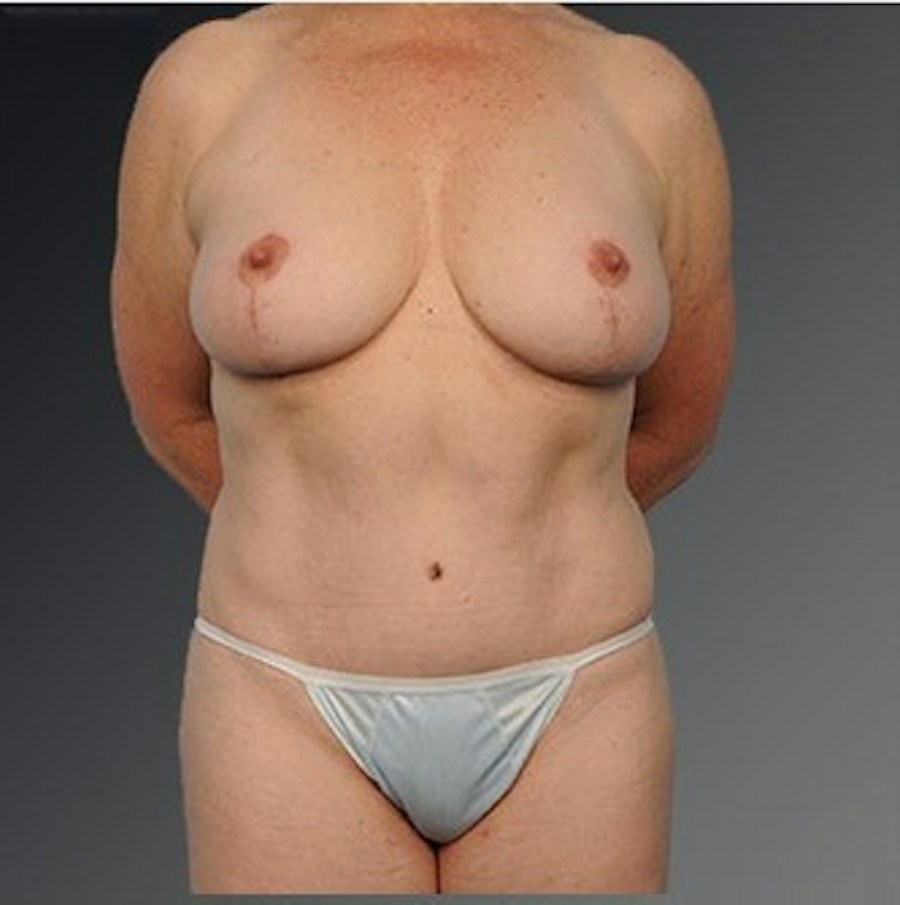 Patient 105741254 | Front View | After | Mommy Makeover — Steven Teitelbaum MD -