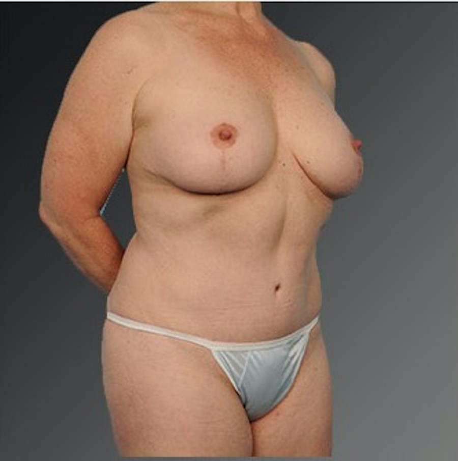 Patient 105741254 | Angle View | After | Mommy Makeover — Steven Teitelbaum MD -