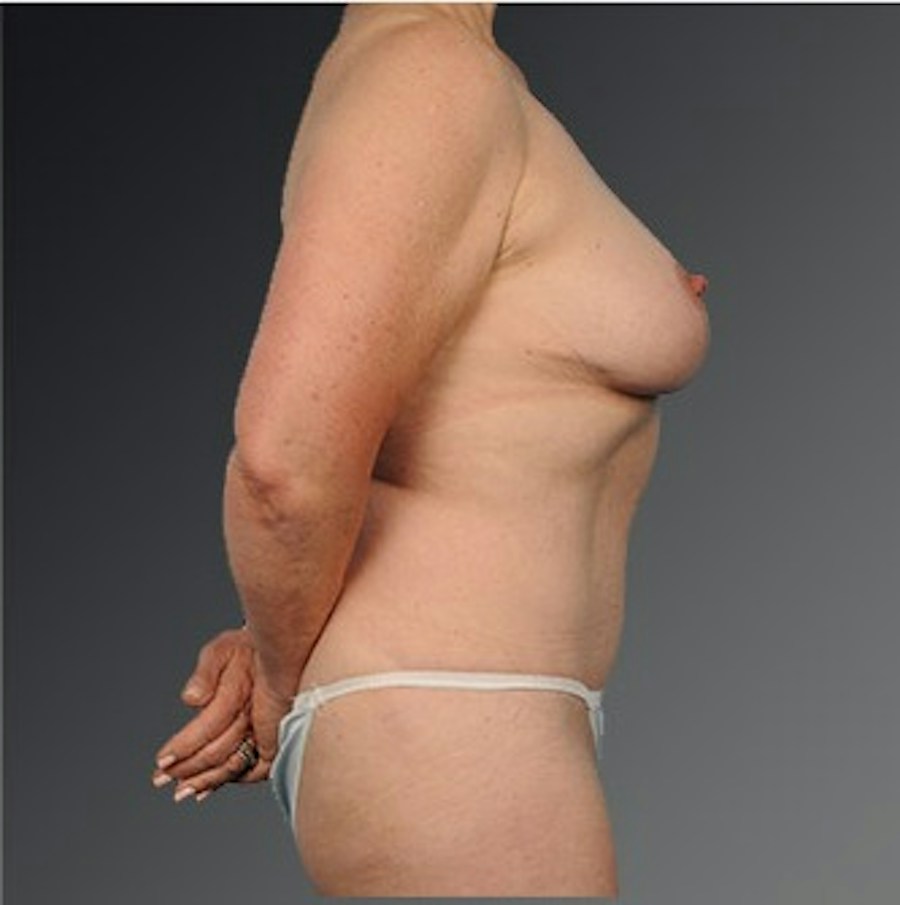 Patient 105741254 | Profile View | After | Mommy Makeover — Steven Teitelbaum MD -