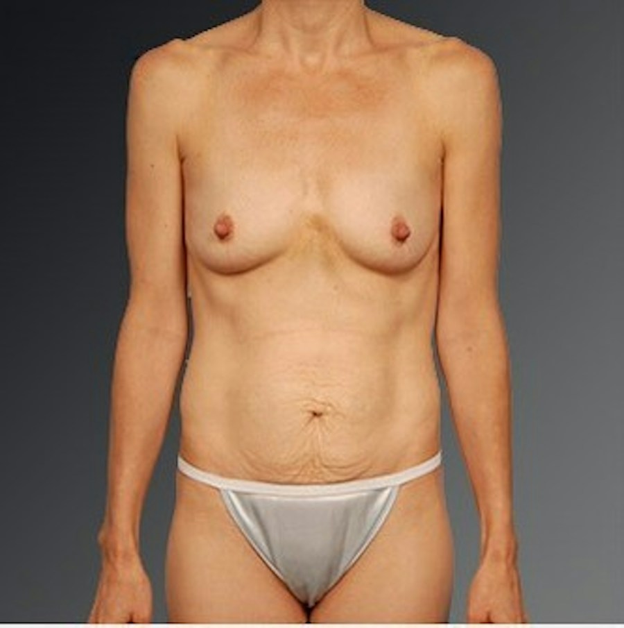 Patient 105741257 | Front View | Before | Mommy Makeover — Steven Teitelbaum MD -