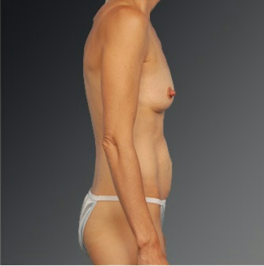 Patient 105741257 | Profile View | Before | Mommy Makeover — Steven Teitelbaum MD -