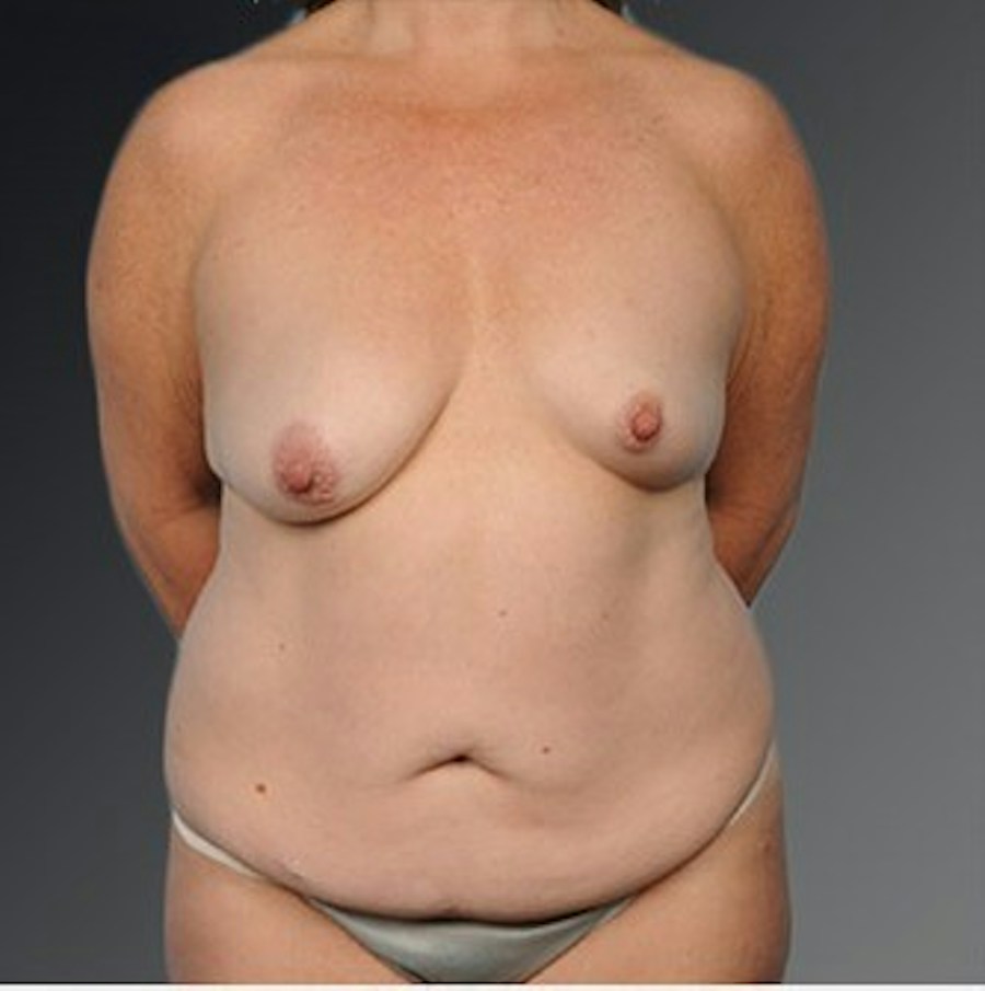 Patient 105747728 | Front View | Before | Mommy Makeover — Steven Teitelbaum MD -