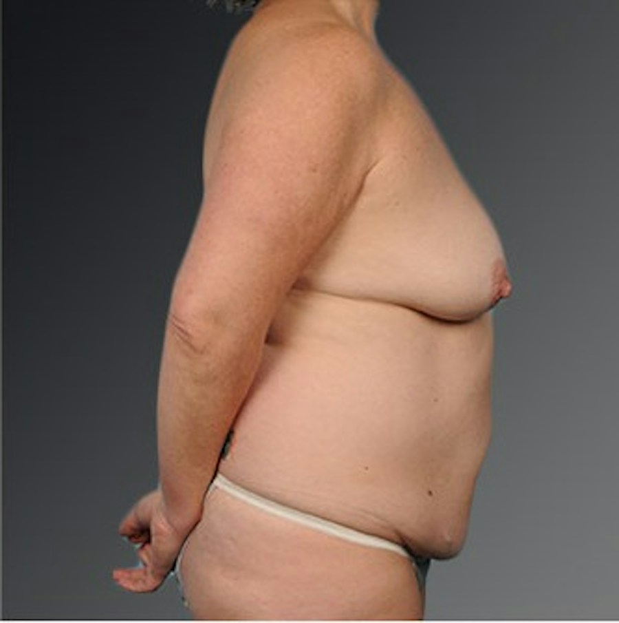 Patient 105747728 | Profile View | Before | Mommy Makeover — Steven Teitelbaum MD -