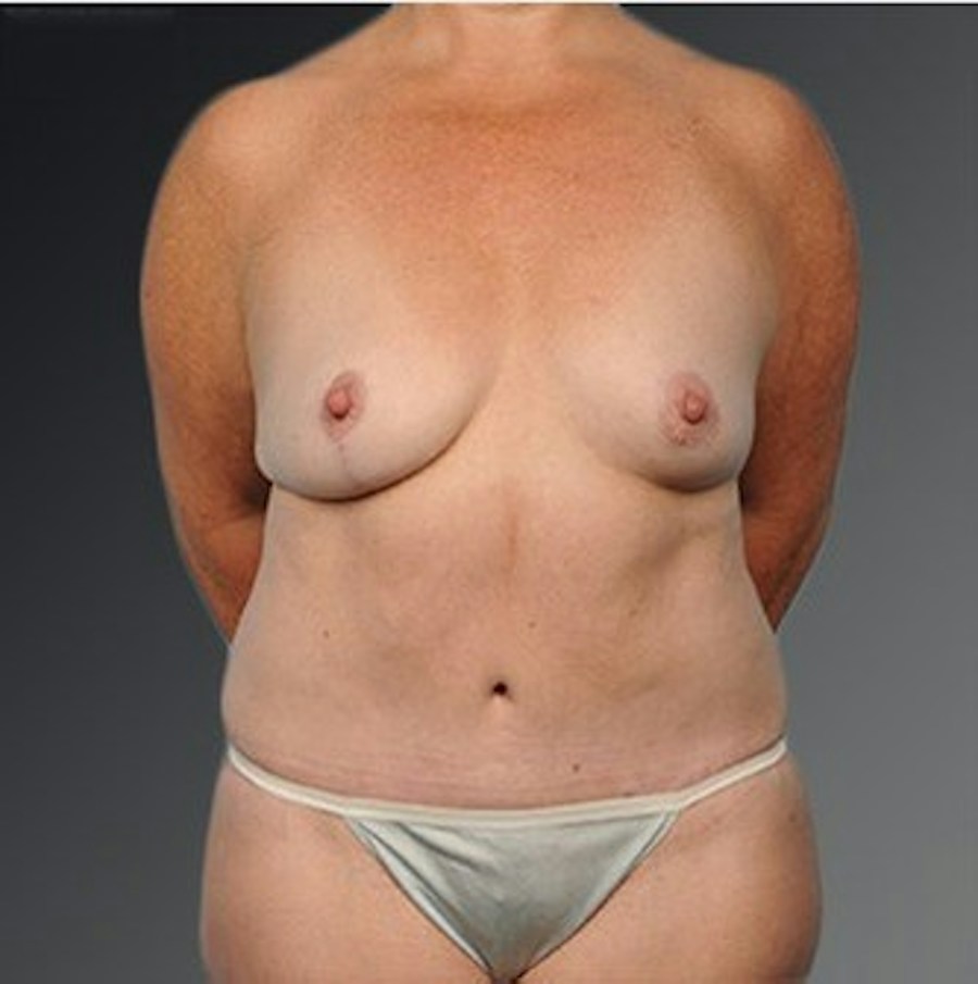 Patient 105747728 | Front View | After | Mommy Makeover — Steven Teitelbaum MD -
