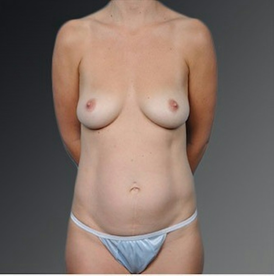 Patient 105747730 | Front View | Before | Mommy Makeover — Steven Teitelbaum MD -
