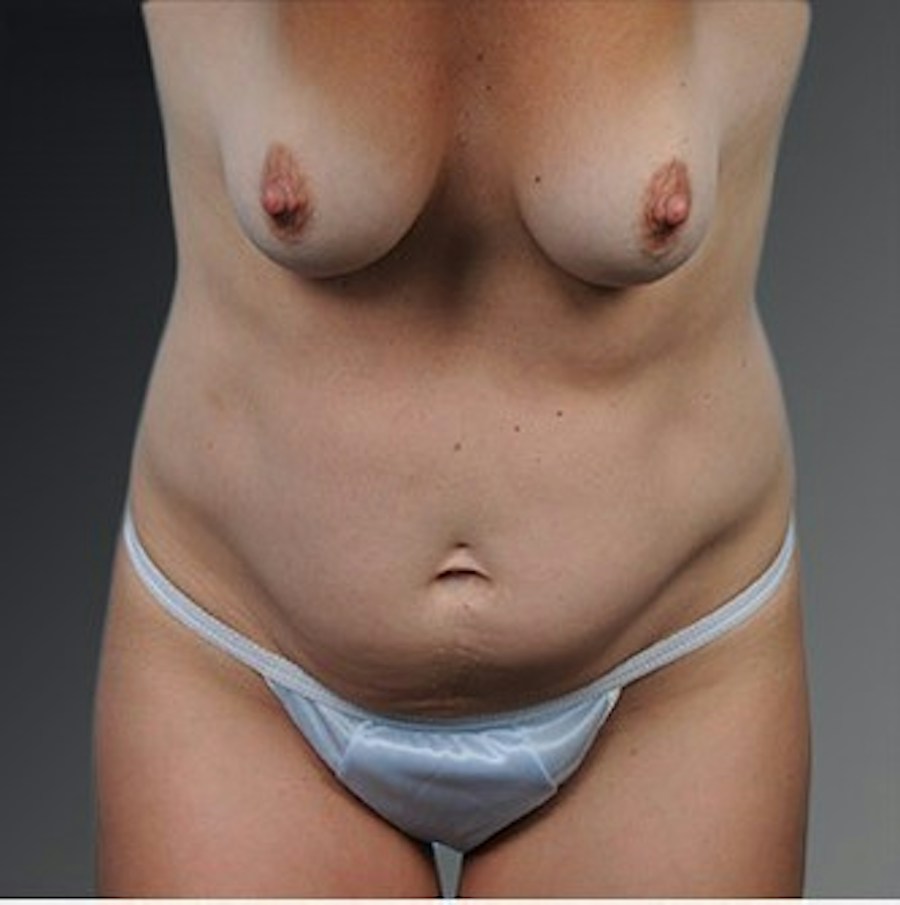 Patient 105747731 | Front View | Before | Mommy Makeover — Steven Teitelbaum MD -