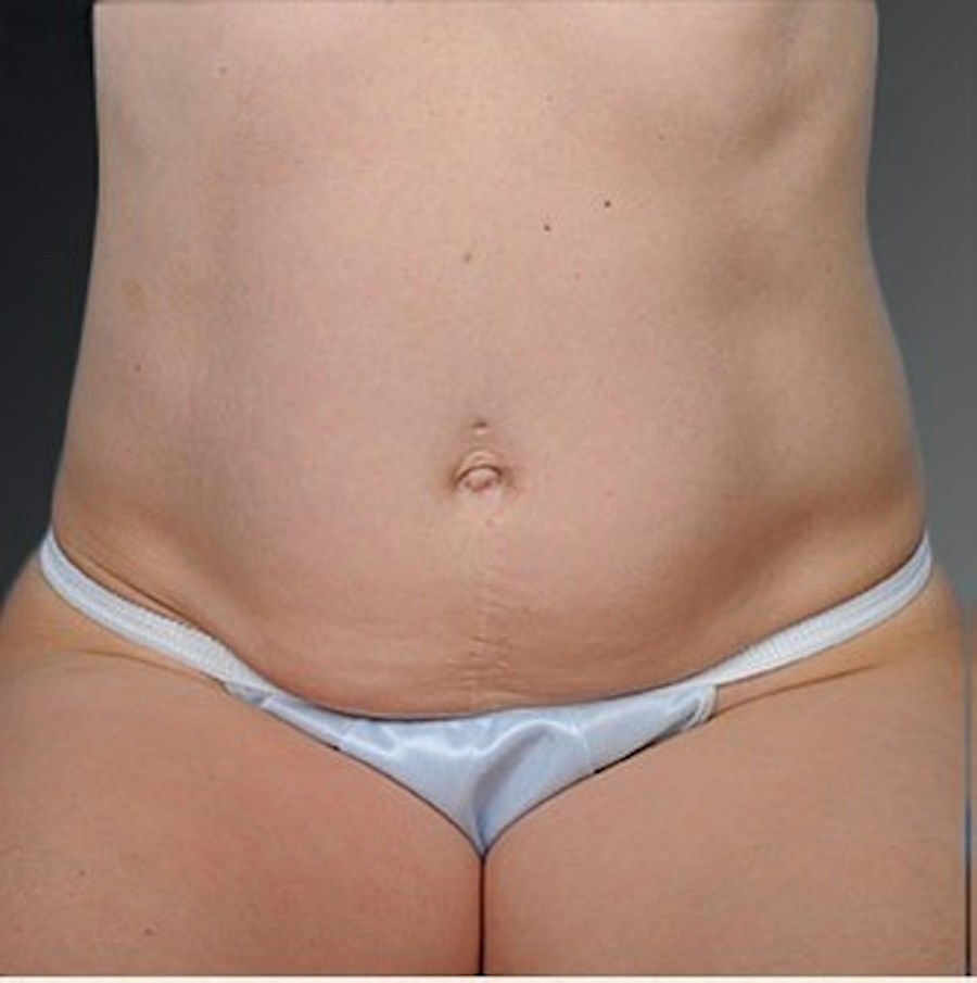 Patient 105747734 | Front View | Before | Mommy Makeover — Steven Teitelbaum MD -