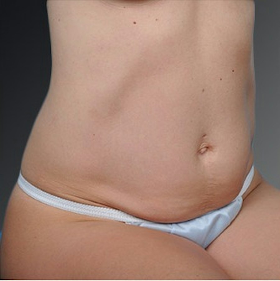 Patient 105747734 | Angle View | Before | Mommy Makeover — Steven Teitelbaum MD -