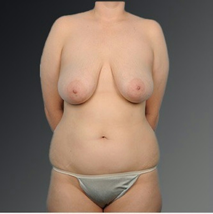 Patient 175628 | Front View | Before | Mommy Makeover — Steven Teitelbaum MD -