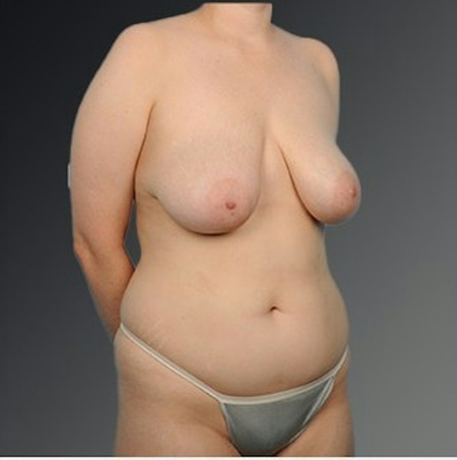 Patient 175628 | Angle View | Before | Mommy Makeover — Steven Teitelbaum MD -