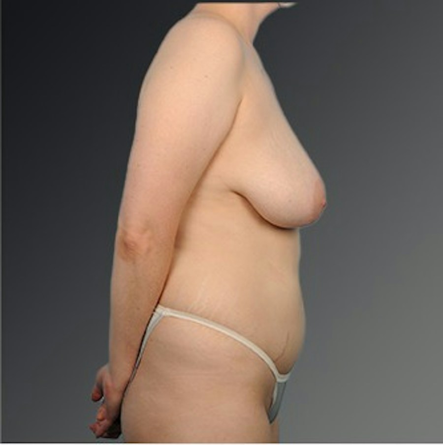 Patient 175628 | Profile View | Before | Mommy Makeover — Steven Teitelbaum MD -