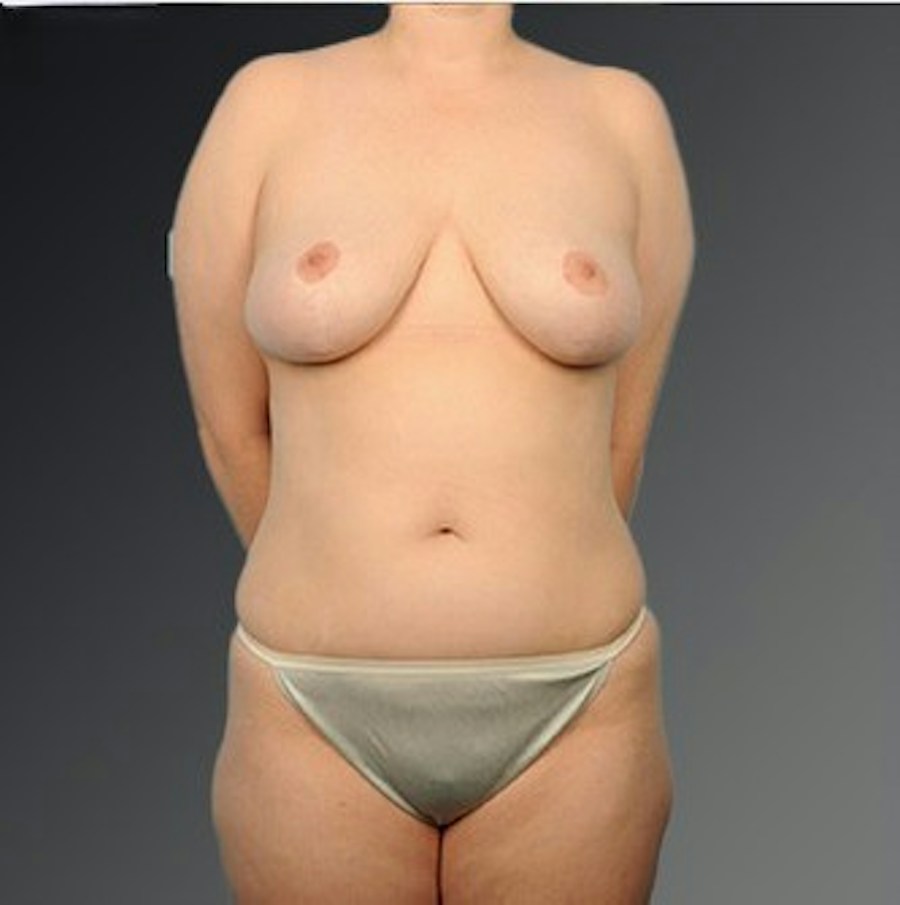 Patient 175628 | Front View | After | Mommy Makeover — Steven Teitelbaum MD -