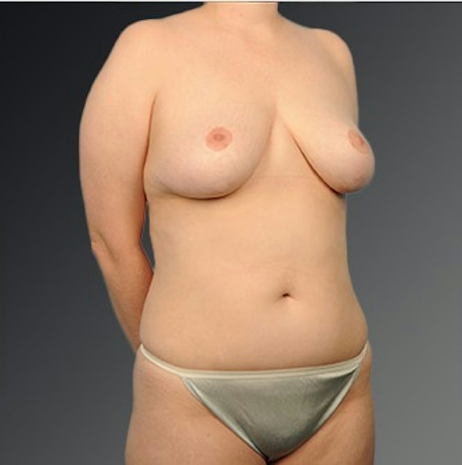 Patient 175628 | Angle View | After | Mommy Makeover — Steven Teitelbaum MD -