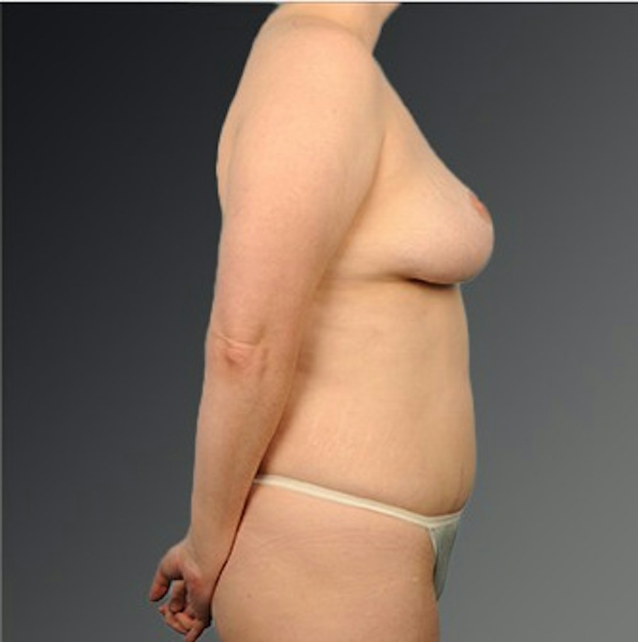 Patient 175628 | Profile View | After | Mommy Makeover — Steven Teitelbaum MD -