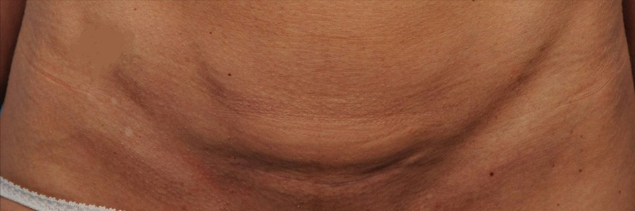 Patient 114188434 | Front View | Before — Steven Teitelbaum MD -