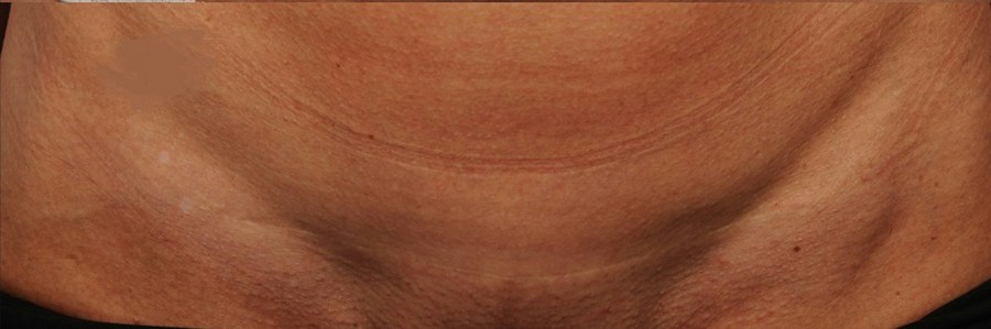 Patient 114188434 | Front View | After — Steven Teitelbaum MD -