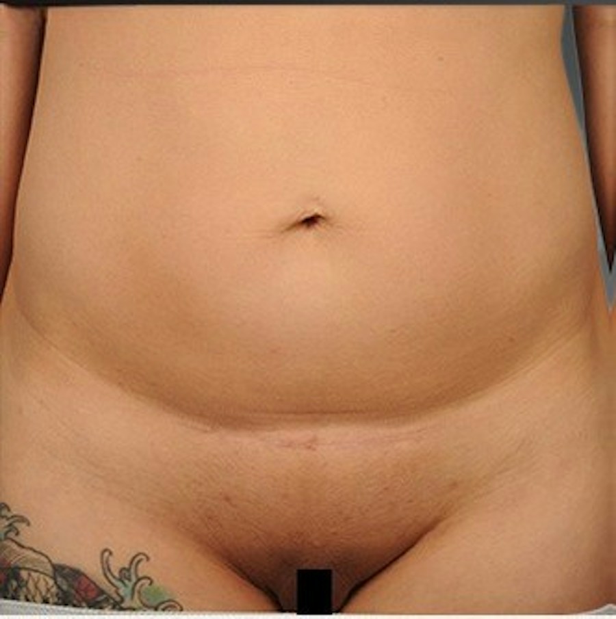 Patient 114188435 | Front View | Before | C-Section Scar Revision — Steven Teitelbaum MD -