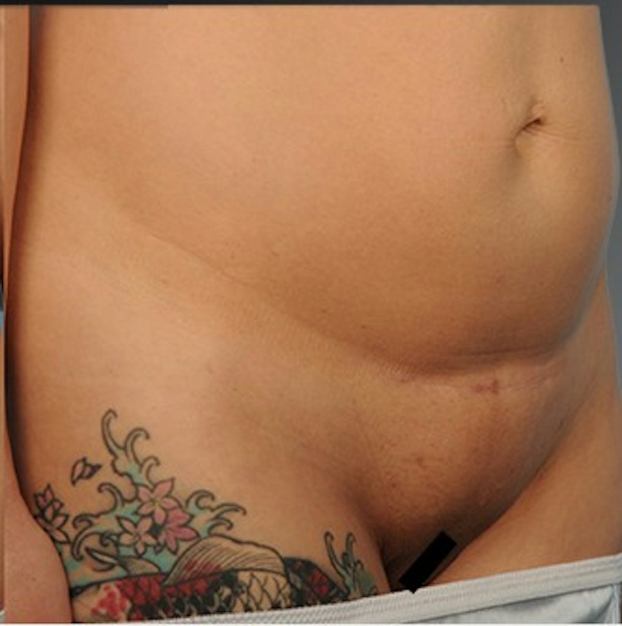Patient 114188435 | Angle View | Before | C-Section Scar Revision — Steven Teitelbaum MD -