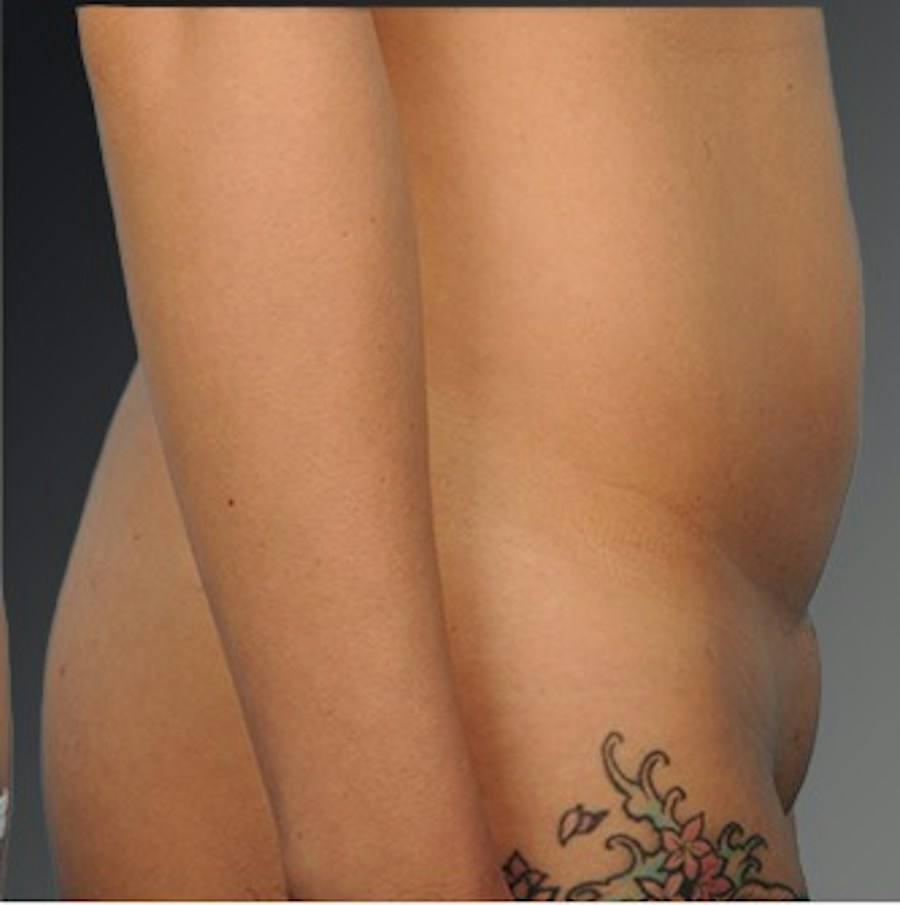 Patient 114188435 | Profile View | Before | C-Section Scar Revision — Steven Teitelbaum MD -