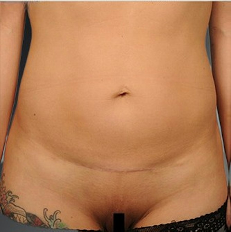 Patient 114188435 | Front View | After | C-Section Scar Revision — Steven Teitelbaum MD -