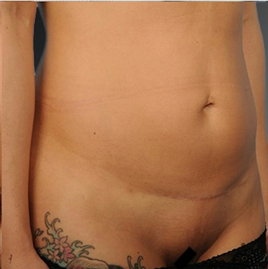 Patient 114188435 | Angle View | After | C-Section Scar Revision — Steven Teitelbaum MD -