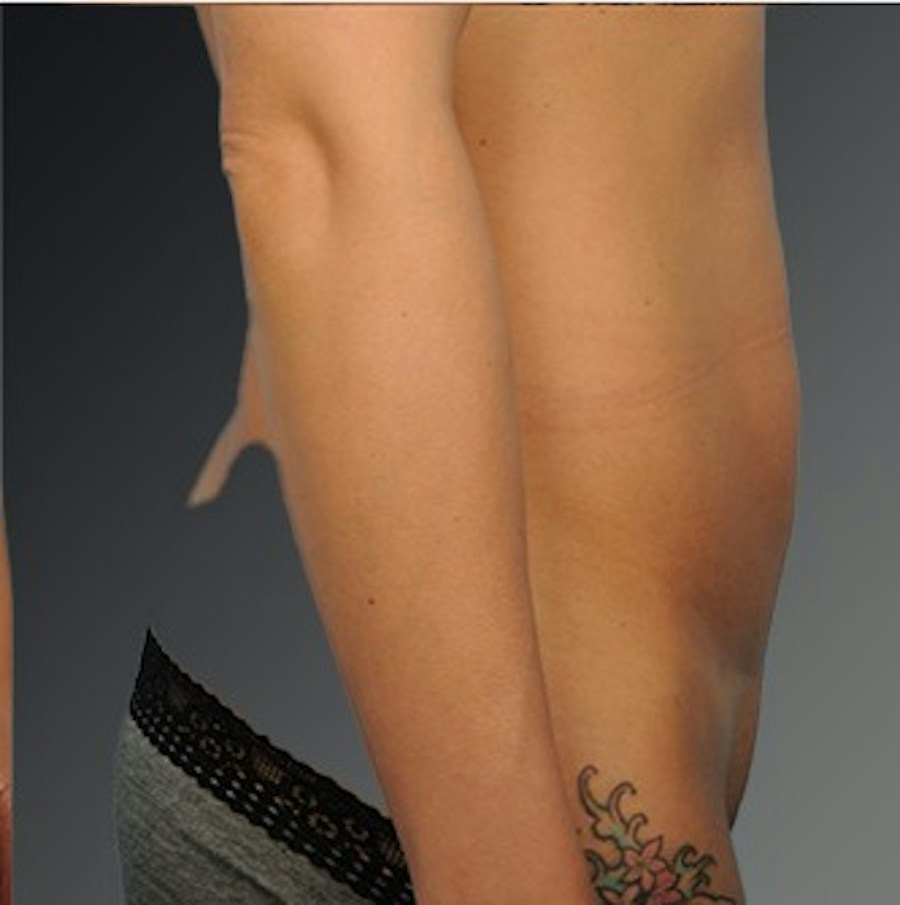 Patient 114188435 | Profile View | After | C-Section Scar Revision — Steven Teitelbaum MD -