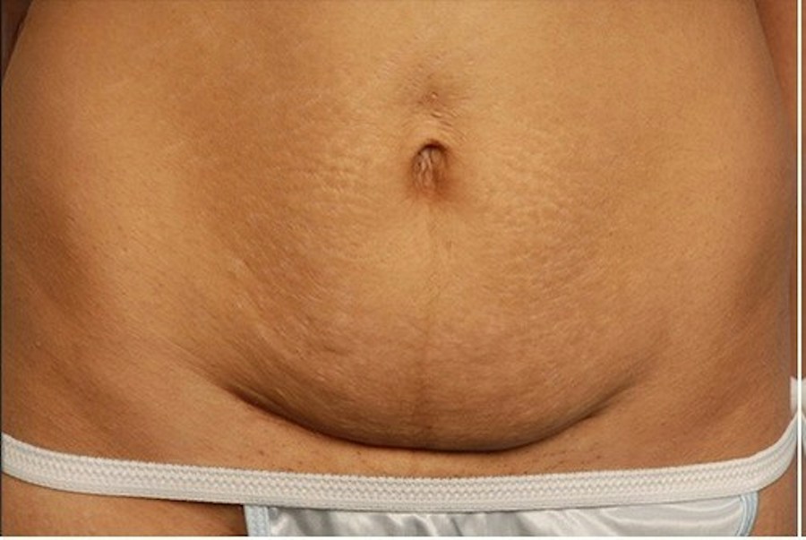 Patient 114188441 | Front View | Before — Steven Teitelbaum MD -