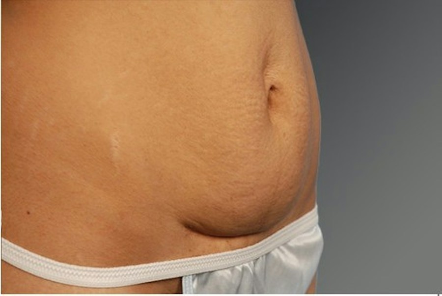 Patient 114188441 | Profile View | Before — Steven Teitelbaum MD -