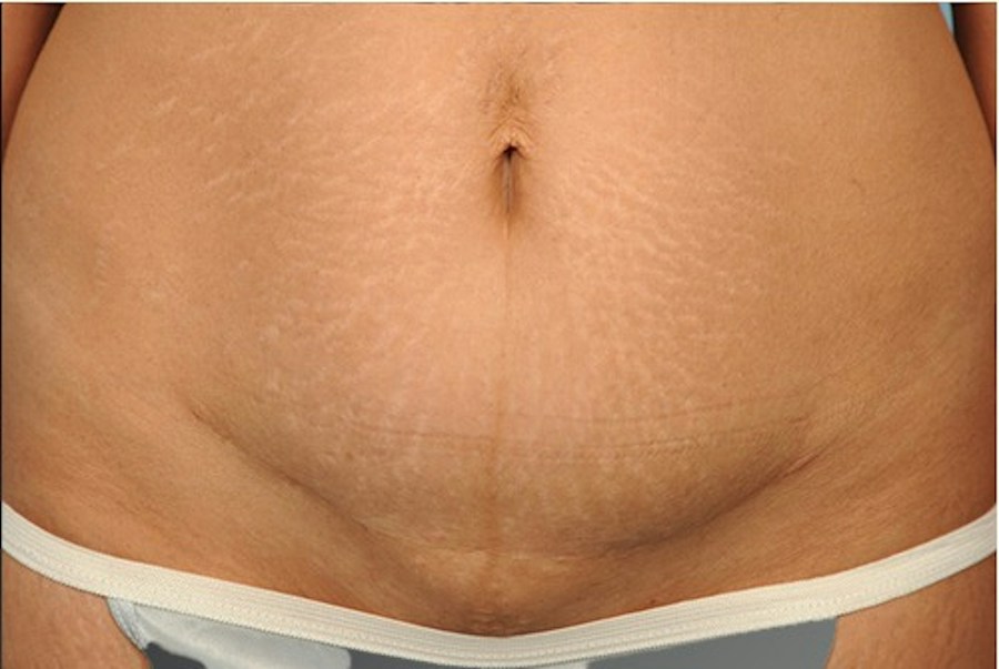 Patient 114188441 | Front View | After — Steven Teitelbaum MD -