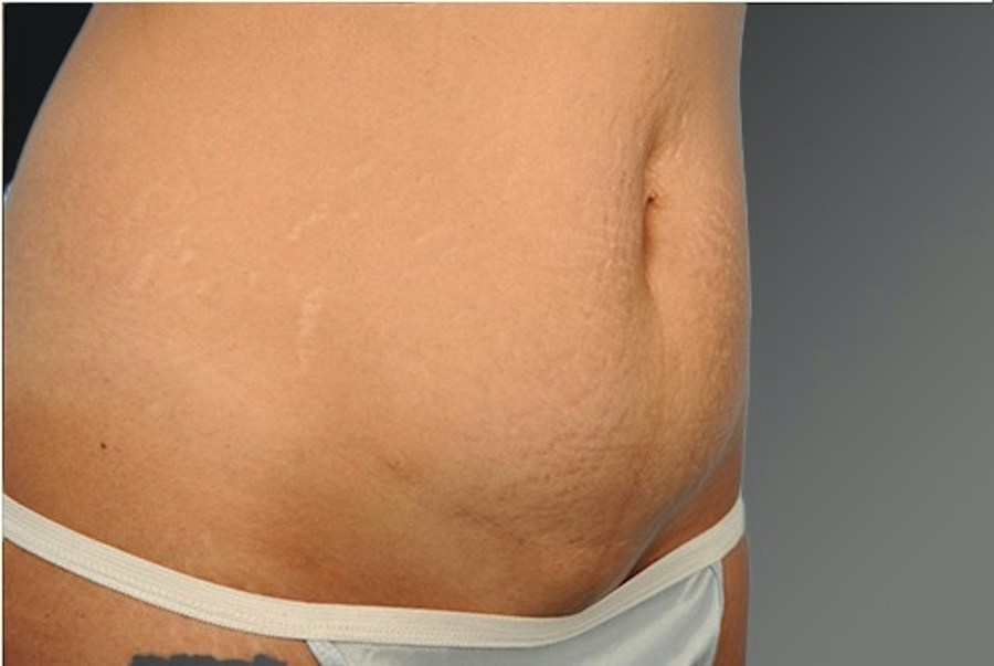 Patient 114188441 | Profile View | After — Steven Teitelbaum MD -