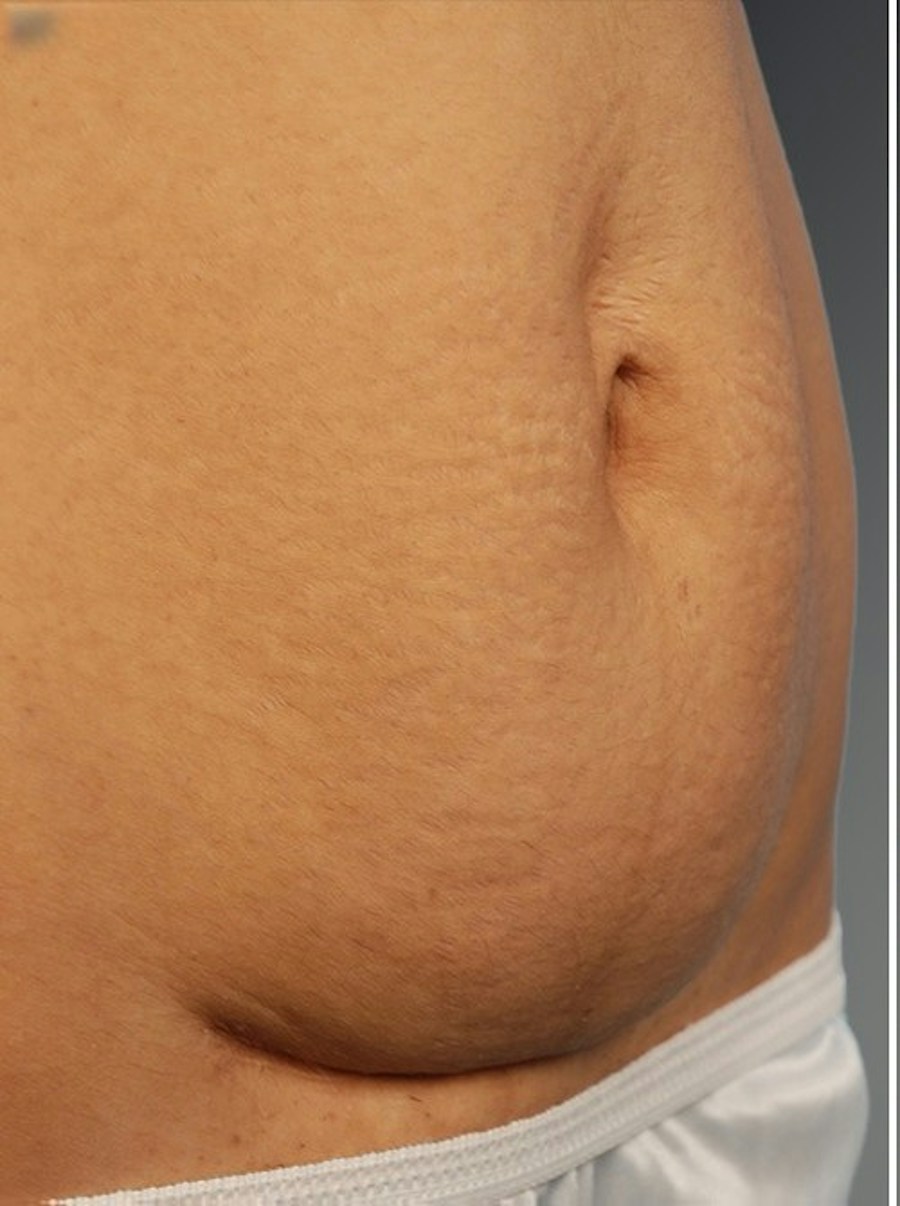 Patient 114188442 | Angle View | Before — Steven Teitelbaum MD -